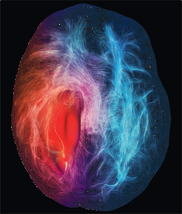 Attaque tumorale du câblage cérébral, par Maxime Chamberland
